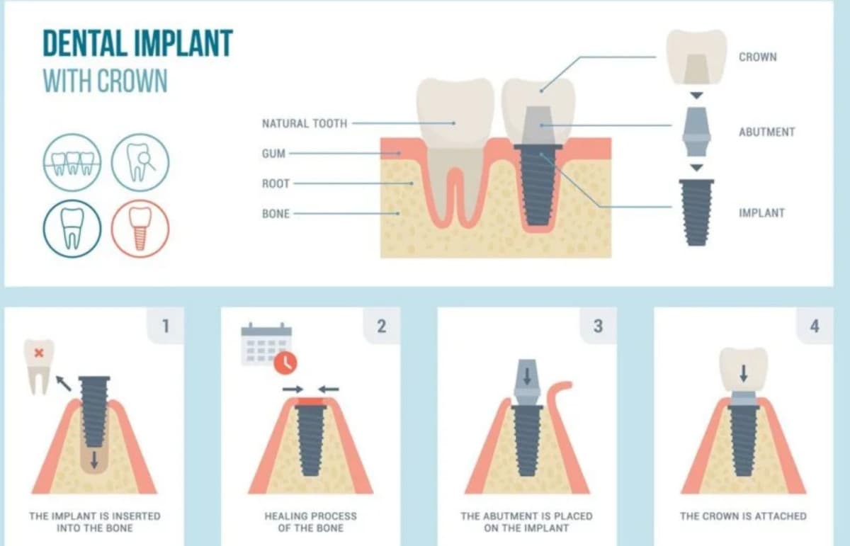 Affordable Dental Implants in Fort Worth: How to Get Quality Care Without Breaking the Bank