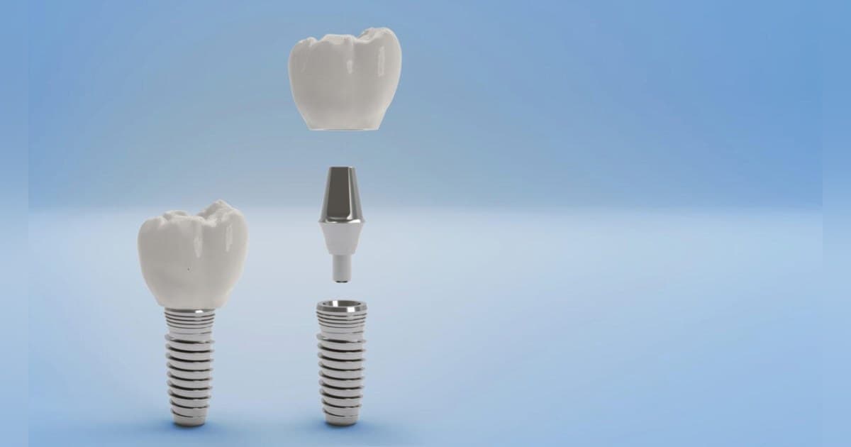 Gunbarrel Dental Center Clarifies Professional Teeth Whitening Options for Boulder Patients